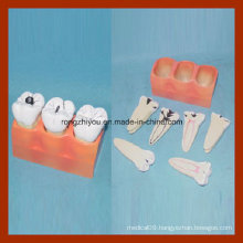 Dental Study Canies Decomposition Tooth Model